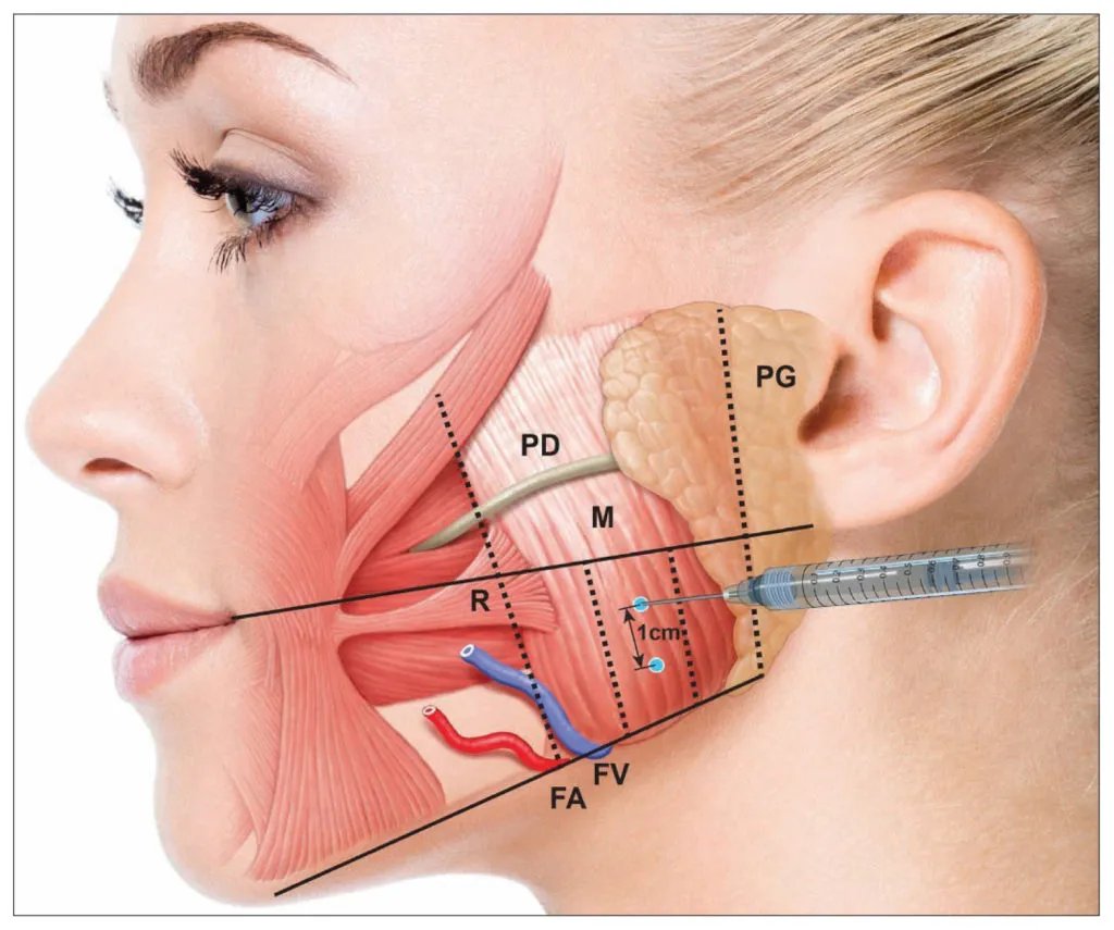 Masseter Botoksu Tedavisi